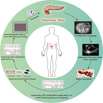 Preclinical models derived from endoscopic ultrasound-guided tissue acquisition for individualized treatment of pancreatic ductal adenocarcinoma